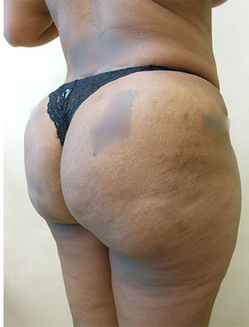 Brazilian Butt Lift Before & After Patient #1222