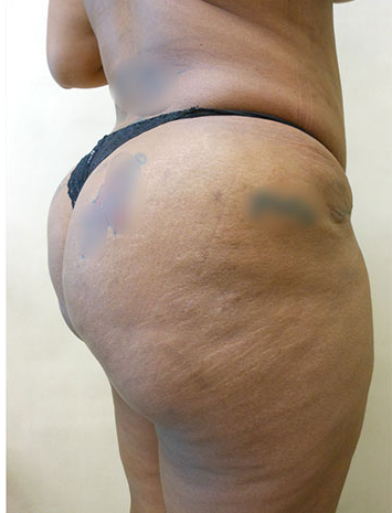 Brazilian Butt Lift Before & After Patient #1222