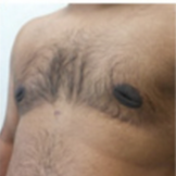 Gynecomastia Before & After Patient #549