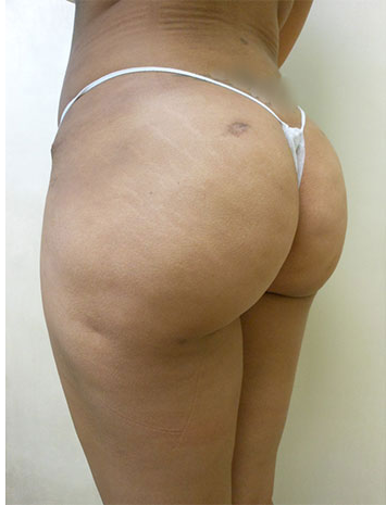 Brazilian Butt Lift Before & After Patient #1223