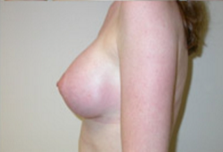 Breast Augmentation Before & After Patient #421