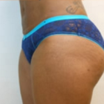 Brazilian Butt Lift Before & After Patient #1133