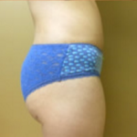 Brazilian Butt Lift Before & After Patient #1135