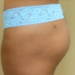 Brazilian Butt Lift Before & After Patient #1136