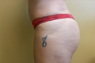 Brazilian Butt Lift Before & After Patient #1137