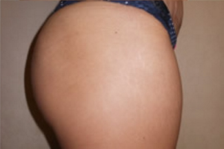 Brazilian Butt Lift Before & After Patient #1138