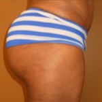 Brazilian Butt Lift Before & After Patient #1140