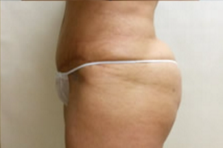Brazilian Butt Lift Before & After Patient #1177