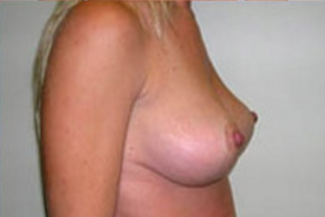 Breast Lift Before & After Patient #426