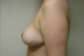 Breast Lift Before & After Patient #427