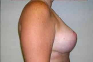 Breast Lift Before & After Patient #428