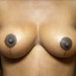 Breast Lift Before & After Patient #429