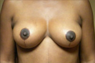 Breast Lift Before & After Patient #429