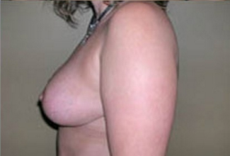 Breast Lift Before & After Patient #430