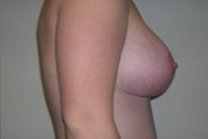 Breast Lift With Augmentation Before & After Patient #460