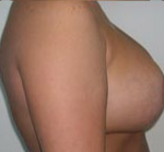 Breast Lift With Augmentation Before & After Patient #461