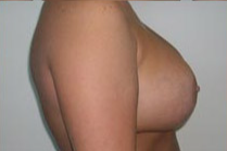 Breast Lift With Augmentation Before & After Patient #461