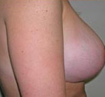 Breast Lift With Augmentation Before & After Patient #463
