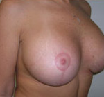 Breast Lift With Augmentation Before & After Patient #464