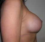 Breast Lift With Augmentation Before & After Patient #467