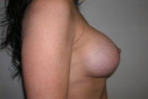 Breast Lift With Augmentation Before & After Patient #467