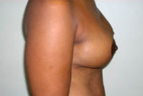 Breast Lift With Augmentation Before & After Patient #500