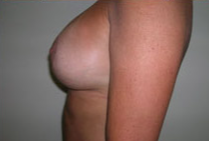 Breast Lift With Augmentation Before & After Patient #501