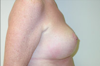 Breast Lift With Augmentation Before & After Patient #502