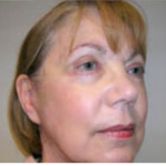 Face Lift Before & After Patient #629