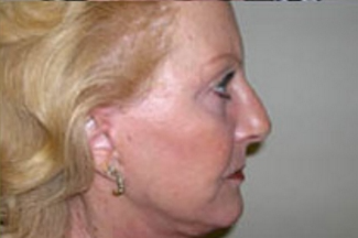 Face Lift Before & After Patient #631