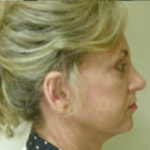 Face Lift Before & After Patient #633
