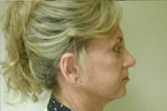 Face Lift Before & After Patient #633