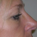 Rhinoplasty Before & After Patient #667