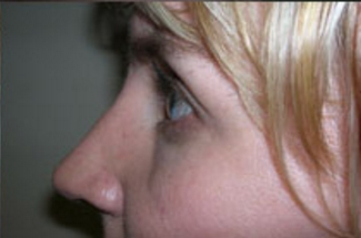Rhinoplasty Before & After Patient #668