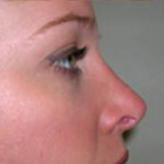 Rhinoplasty Before & After Patient #670