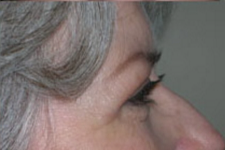 Blepharoplasty Before & After Patient #704