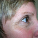 Blepharoplasty Before & After Patient #707