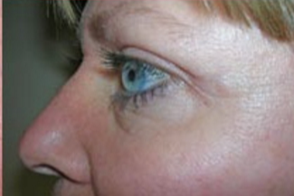 Blepharoplasty Before & After Patient #733