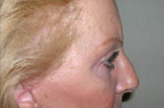 Blepharoplasty Before & After Patient #734