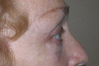 Browlift Before & After Patient #770
