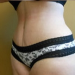 Abdominoplasty Before & After Patient #780