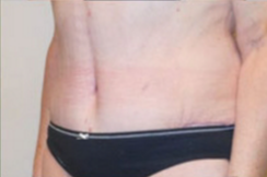 Abdominoplasty Before & After Patient #781