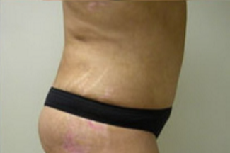 Abdominoplasty Before & After Patient #786
