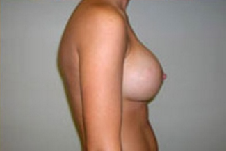 Breast Augmentation Before & After Patient #373