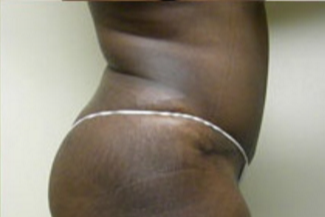 Abdominoplasty Before & After Patient #787