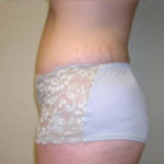 Abdominoplasty Before & After Patient #844
