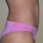 Abdominoplasty Before & After Patient #847