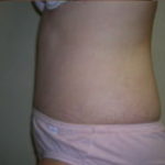 Abdominoplasty Before & After Patient #849