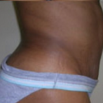 Abdominoplasty Before & After Patient #850