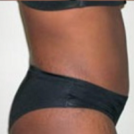 Abdominoplasty Before & After Patient #894